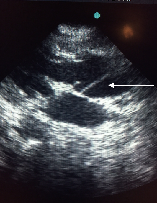 Transthoracic echo demonstrating aortic dissection flap in parasternal long axis view.