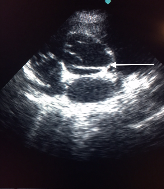 Figure 4 B: TRANSTHORACIC ECHO SHOWING (SHORT AXIS VIEW) AORTIC DISSECTION FLAP ALMOST AT AORTIC VALVE LEAFLETS LEVEL.