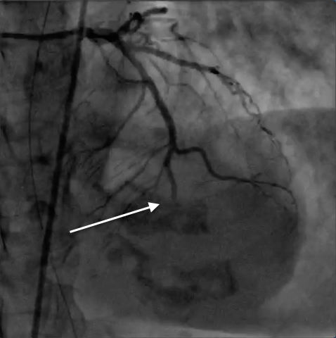 FIGURE 3: TOTALLY OCCLUDED LEFT ANTERIOR DESCENDING CORONARY ARTERY AT MID-DISTAL REGION (WHITE ARROW).