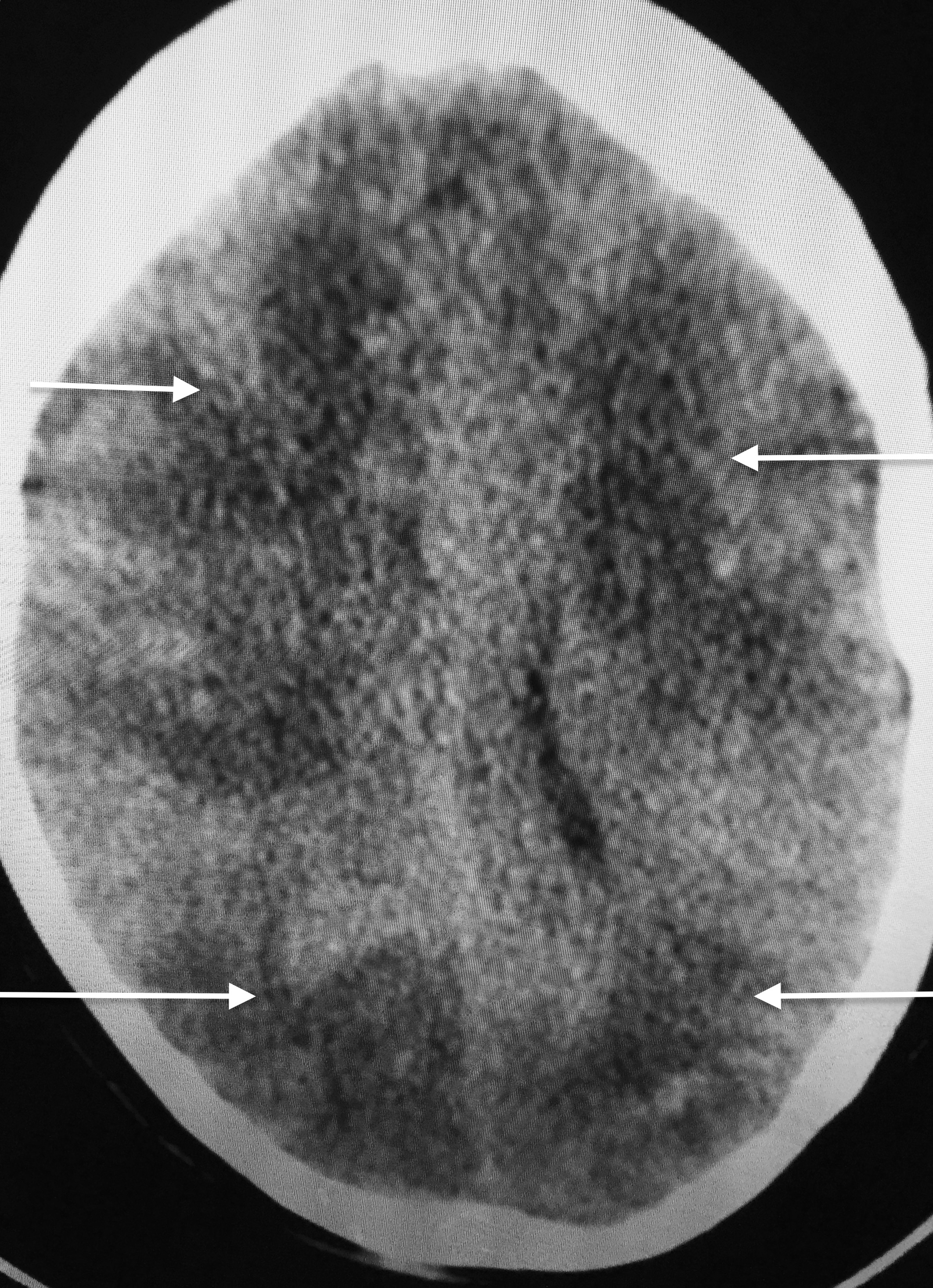 FIGURE 4 : MRI SHOWING LARGE MULTIPLE EMBOLIC INFARCTS FROM LEFT ATRIAL MYXOMA IN BOTH CEREBRAL HEMISPHERES (WHITE ARROWS).