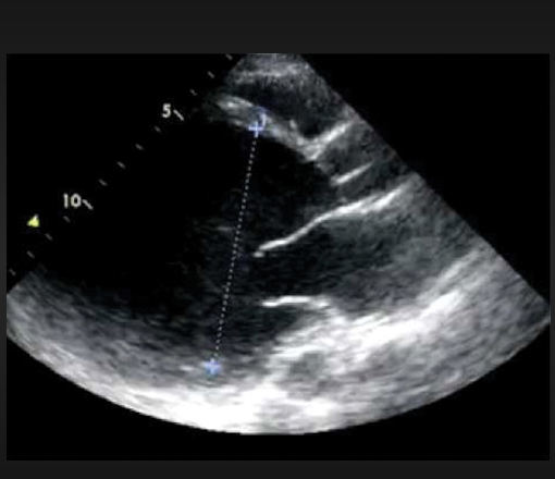 PARA STERNAL LONG AXIS 2 D ECHOCARDIOGRAM DEMONSTRATING A DILATED LEFT VENTRICLE IN PERIPARTUM CARDIOMYOPATHY.