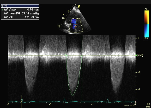 Doppler showing V max >4 m/s and mean gradient >50 mm Hg across aortic valve.