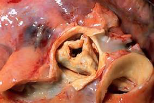 Aortic Stenosis.