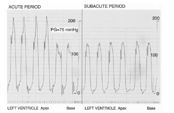LEFT VENTRICULAR OUTFLOW TRACT OBSTRUCTION IN TAKOTSUBO SYNDROME.