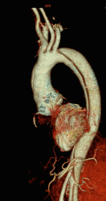 TYPE A AORTIC DISSECTION EXTENDING FROM ASCENDING THORACIC AORTA TO THE THE DESCENDING THORACO-ABDOMINAL AORTA.