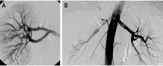 (A) MULTIFOCAL FIBRODYSPLASIA OF RIGHT RENAL ARTERY, (B) FOCAL FIBRO DYSPLASIA OF RIGHT RENAL ARTERY