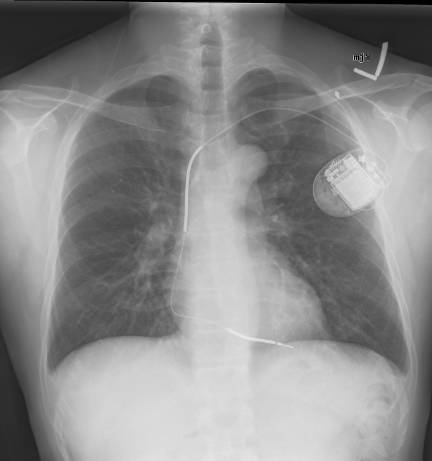 implantable_cardioverter_defibrillator_chest_x-ray