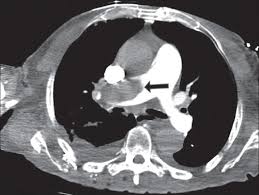 CT PULMONARY ANGIOGRAM SHOWING LARGE EMBOLUS IN RIGHT PULMONARY ARTERY
