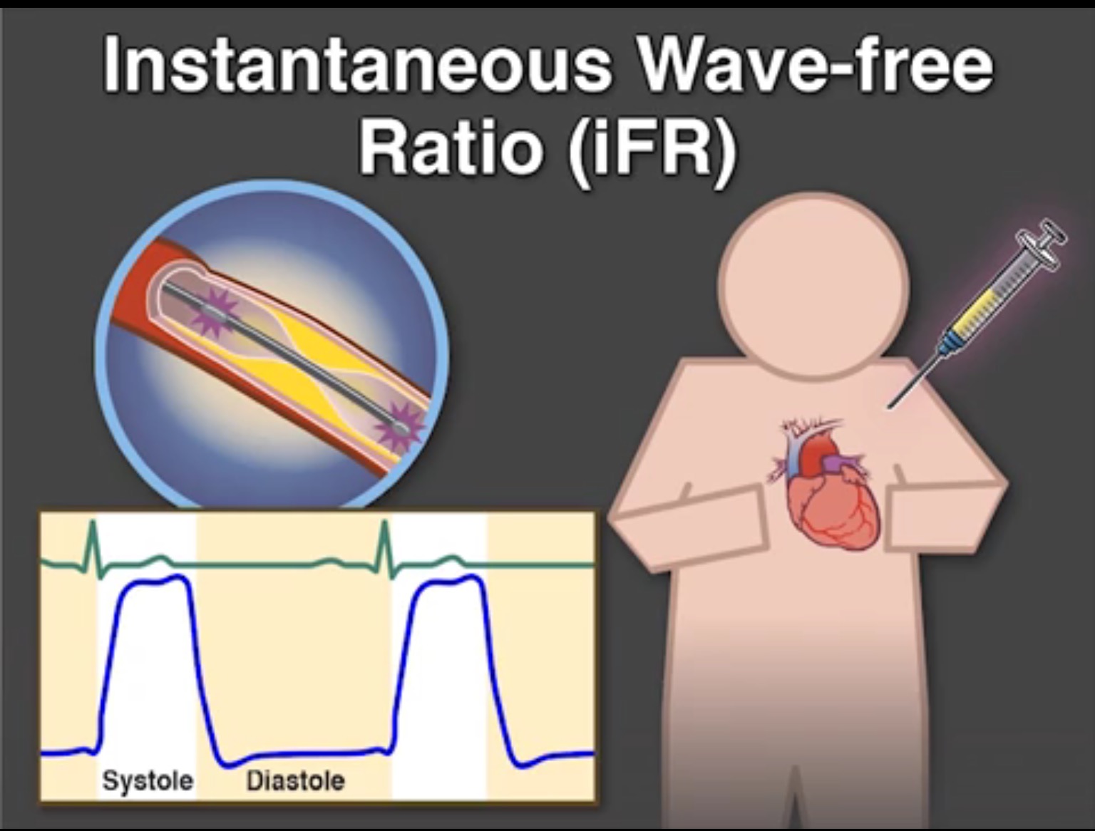 INSTANTANEOUS WAVE FREE RATIO IS CALCULATED DURING DIASTOLE WITHOUT NEED FOR HYPERAEMIA 