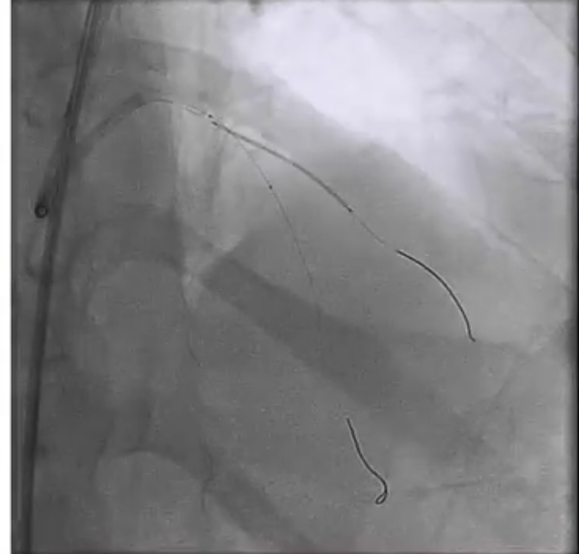 BALLLOON IN MAIN BRANCH AND DES STENT IN SIDE BRANCH